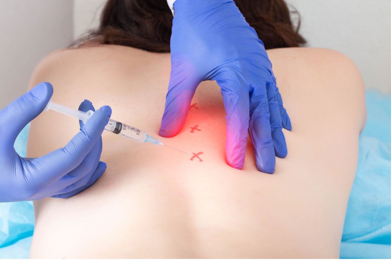 Understanding the Distinctions: Facet Injections vs. Epidural Injections for Chronic Pain Relief